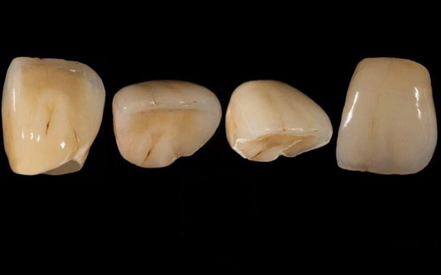 Unsere Vollkeramikkronen und Keramikinlays sind dem natürlichen Zahn in Form, Größe und Farbe nachempfunden