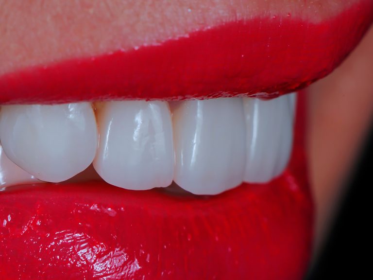 Veneers Bad Honnef bei Bonn Patienteninfos zu Veneers
